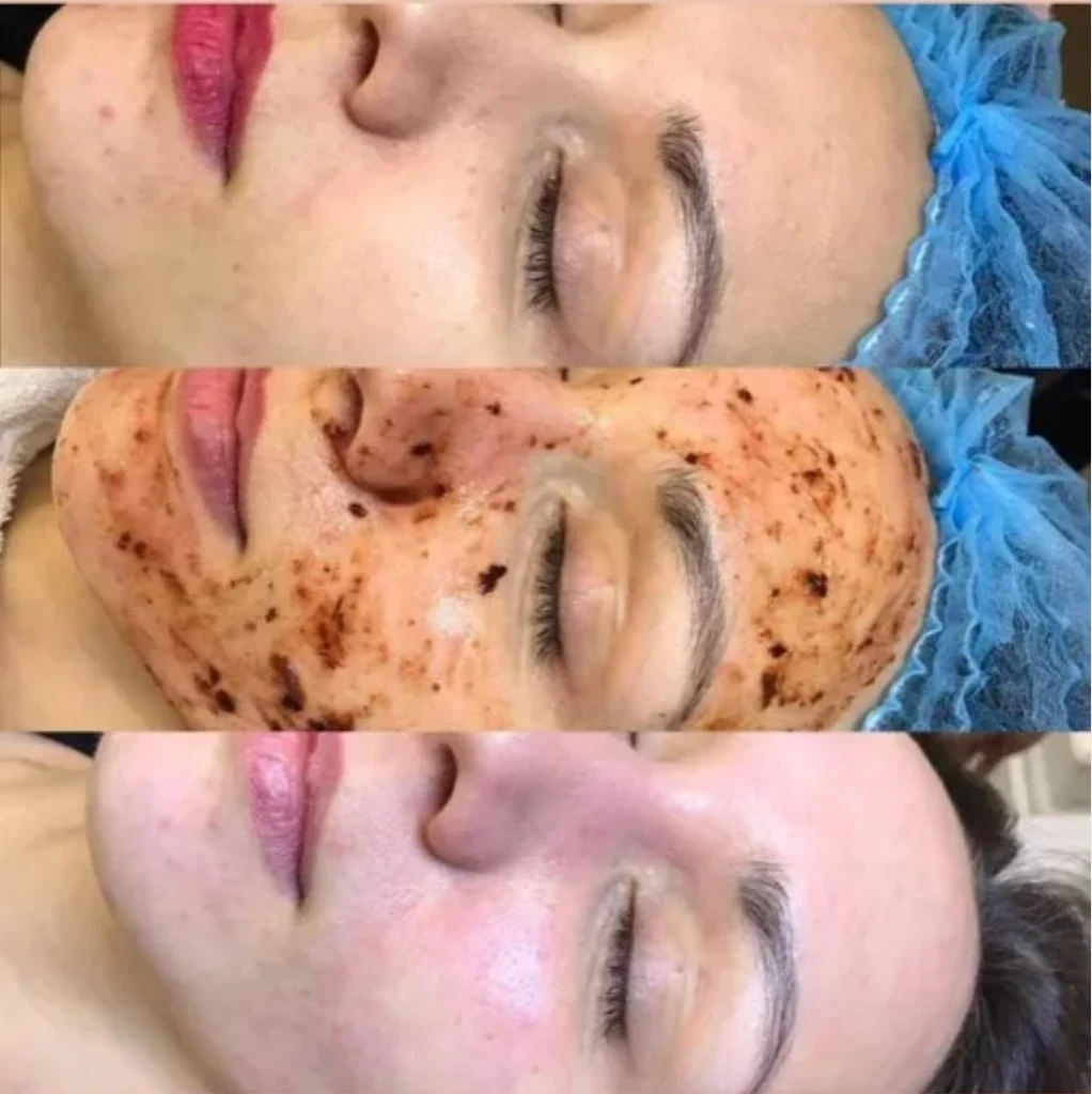 Before and after cosmetology facial skin treatment results
