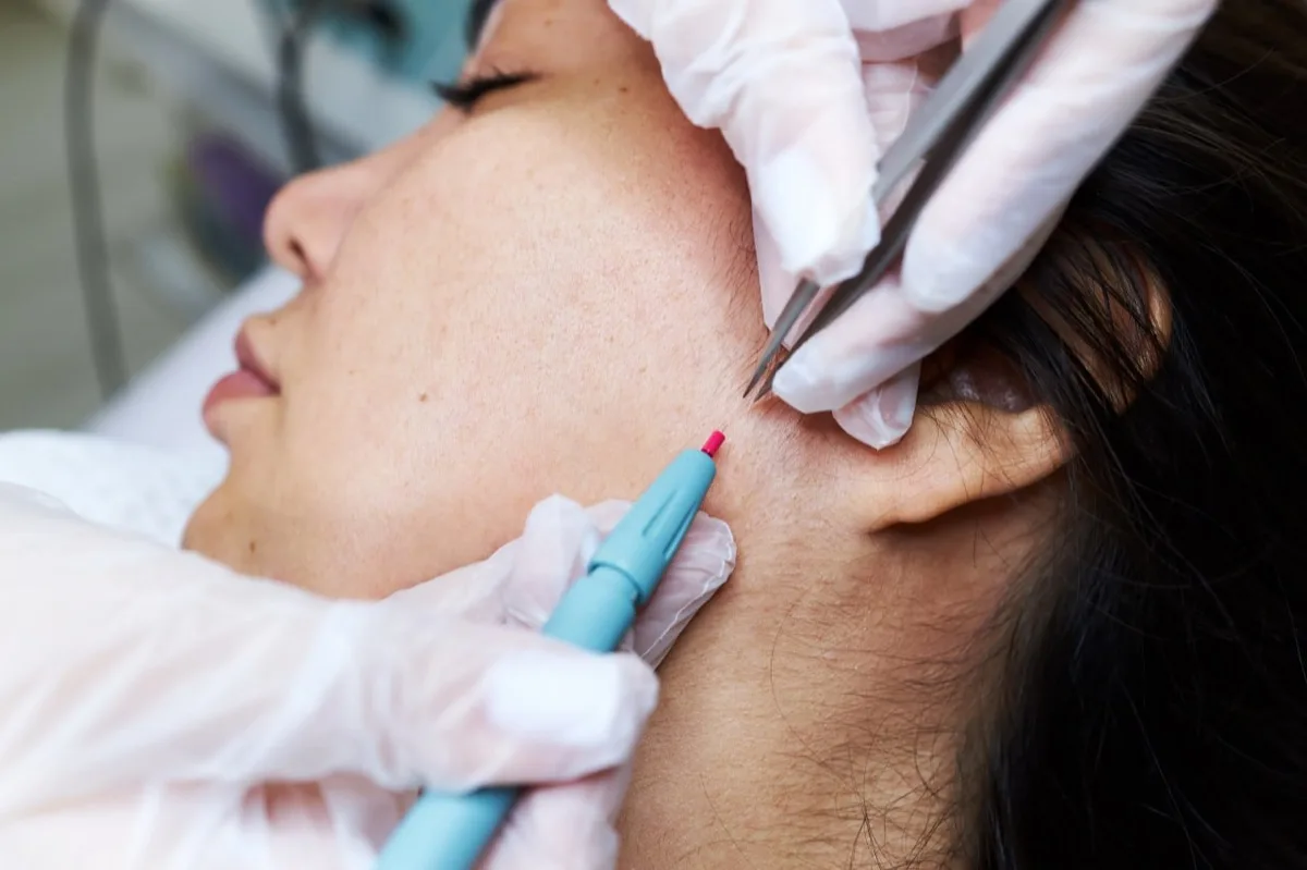 Electrolysis training procedure, permanent hair removal course