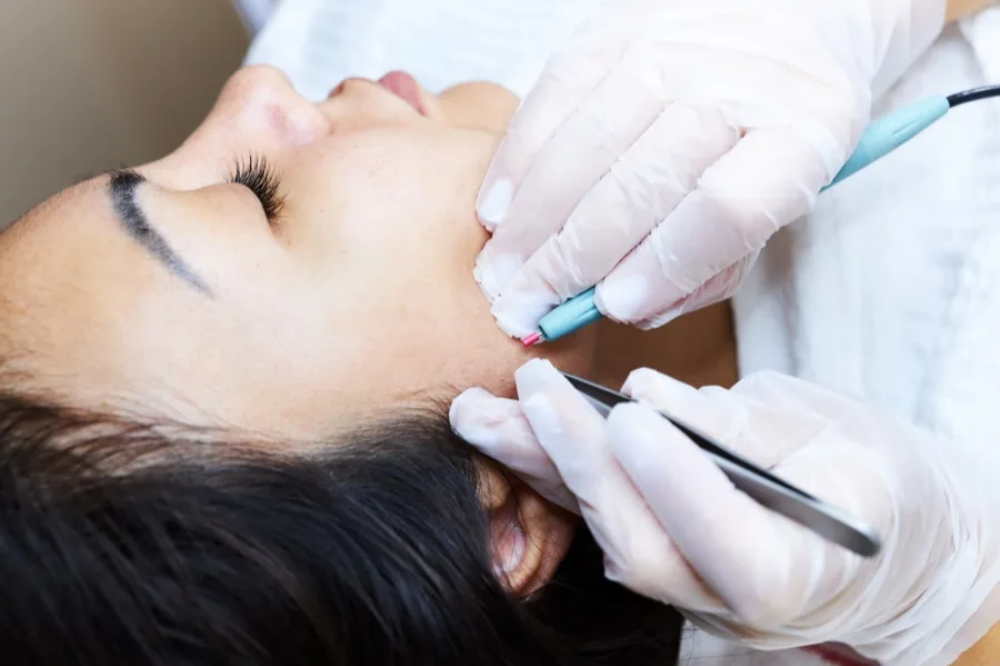 Electrolysis training practice, chin area treatment